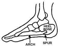 Heel Spur